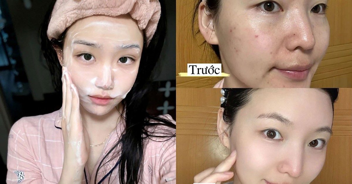 Top 7 sữa rửa mặt ngừa mụn giúp da sạch sâu, mụn giảm nhanh chóng