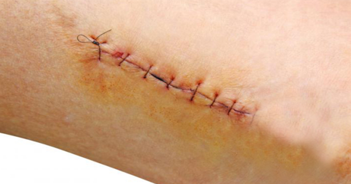 Vai trò kiểm soát viêm sớm trong giảm sẹo hậu phẫu