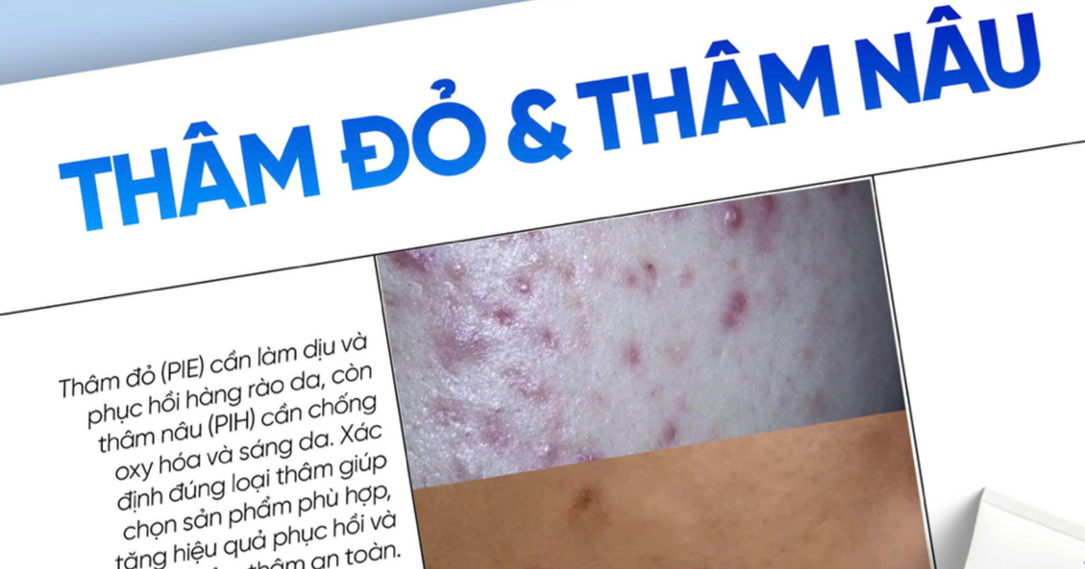 Top cách chăm sóc da thâm đỏ sau mụn bạn nên thử ngay trong routine hằng ngày