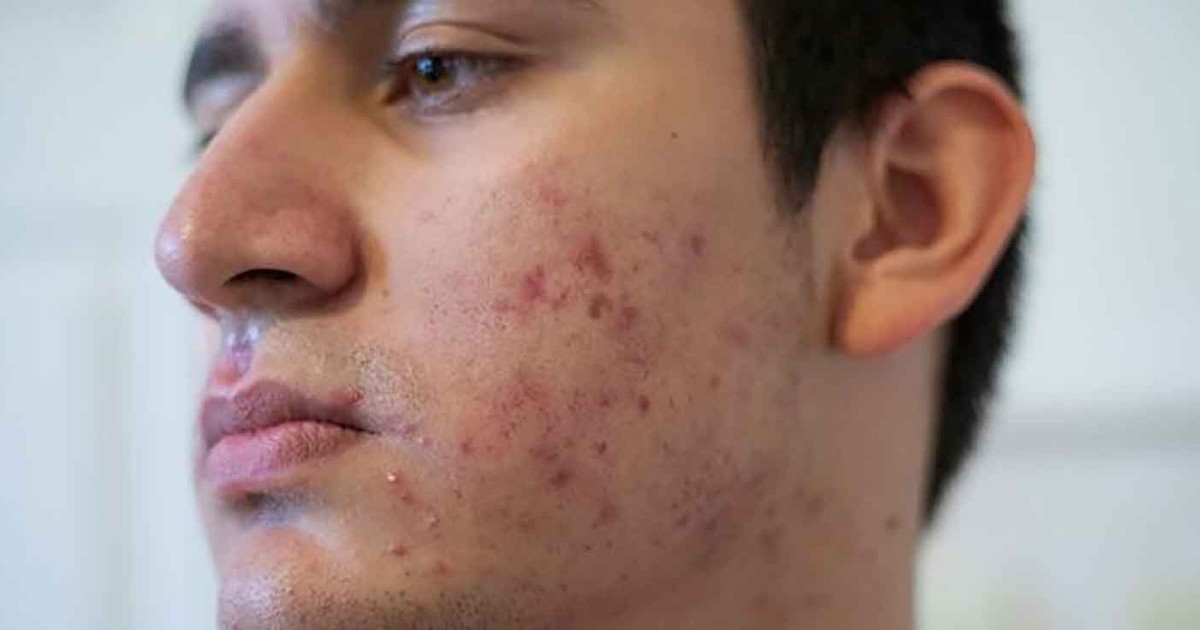 Nam giới bị sẹo rỗ: Khi nào da còn khả năng tăng sinh collagen để cải thiện?