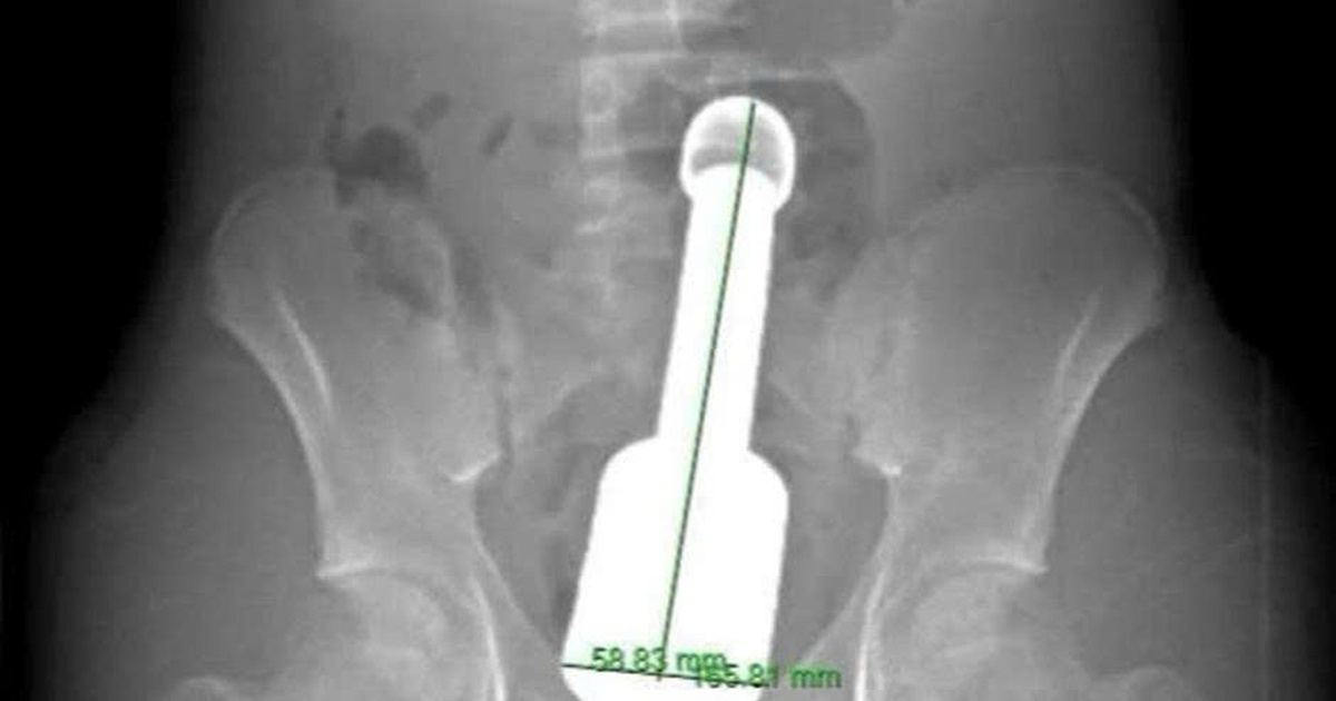 Chày kim loại kẹt trong trực tràng khiến thiếu niên 15 tuổi phải cấp cứu trong đêm