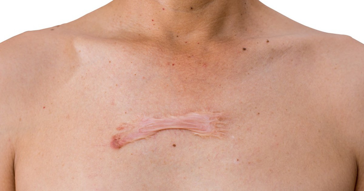 30 - 50% nguy cơ sẹo lồi xuất phát từ một yếu tố ít được nhắc đến