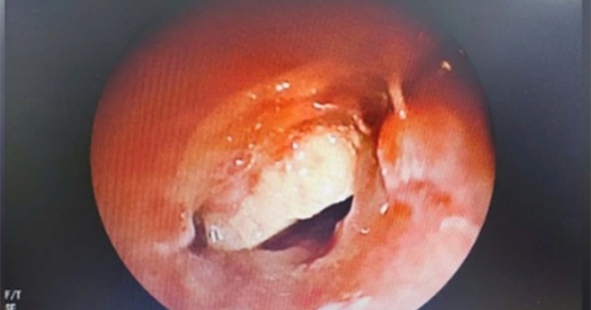 Nằm võng ăn bánh hạnh nhân, thiếu niên suýt mất mạng vì hóc dị vật