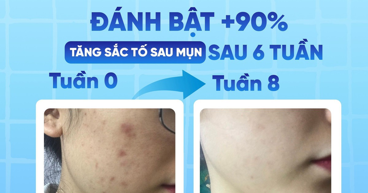 Scar Esthetique giúp mờ sẹo thâm có tốt không mà thuộc top bán chạy nhiều năm qua?