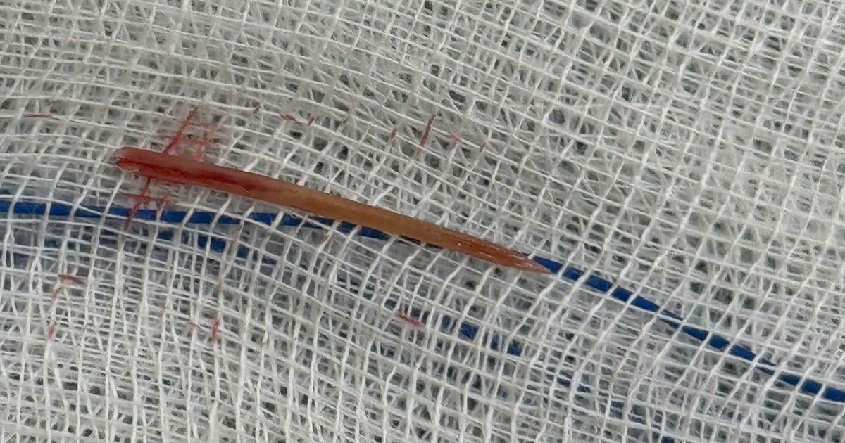 Đau bụng 5 ngày, đi khám phát hiện xương cá đâm xuyên ruột non