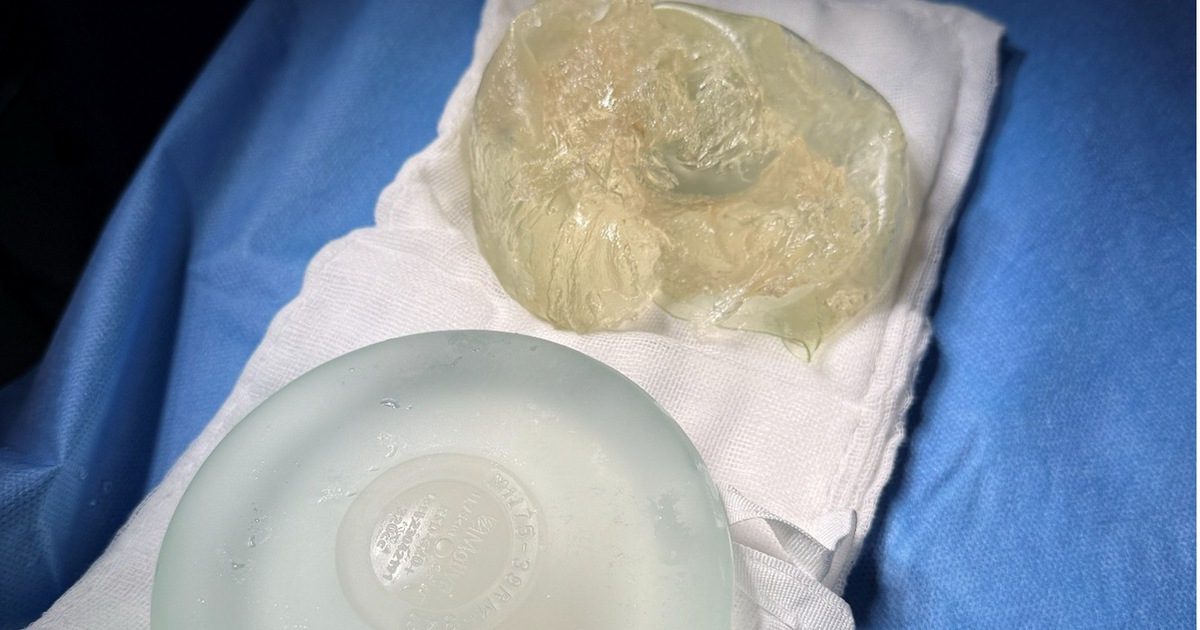 Ths.Bs Hồ Cao Vũ chia sẻ về: Nguyên nhân, dấu hiệu, quy trình tháo túi ngực vỡ