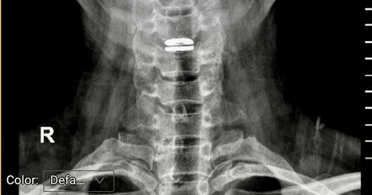 Sai lầm khi trị đau cổ vai gáy có thể gây liệt