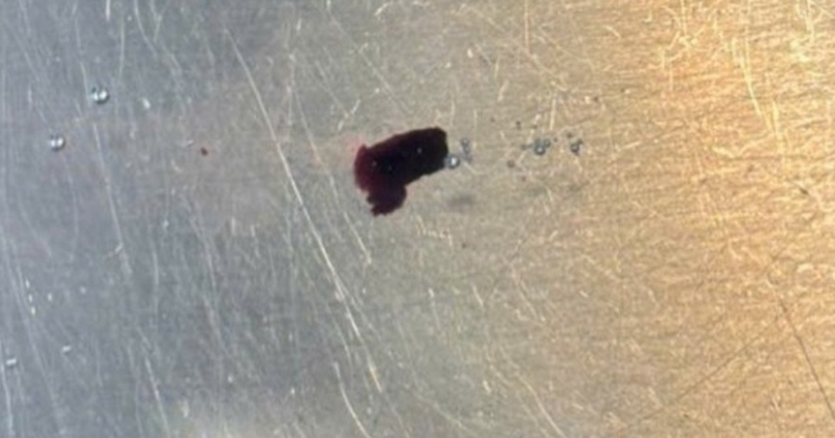 Hy hữu: Mảnh kim loại bắn xuyên tinh hoàn nam thanh niên khi đang làm việc