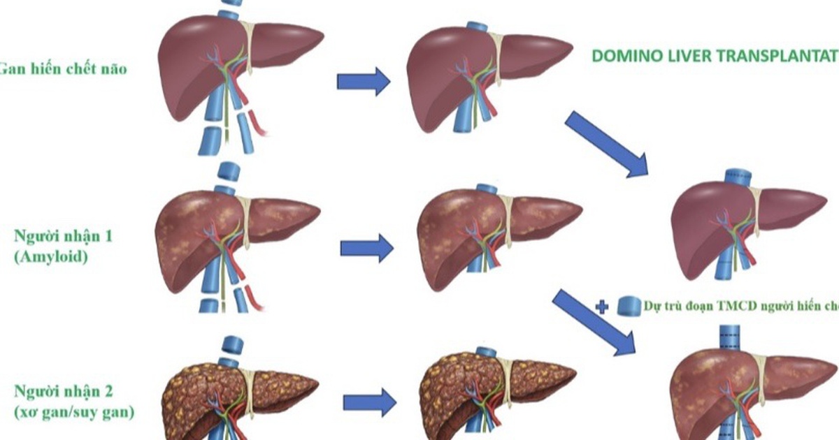Lần đầu tiên Việt Nam ghép đa tạng domino