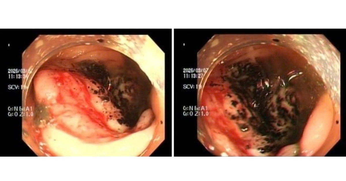 Đau bụng tưởng bình thường, nhiều người trẻ mắc ung thư đại trực tràng giai đoạn muộn