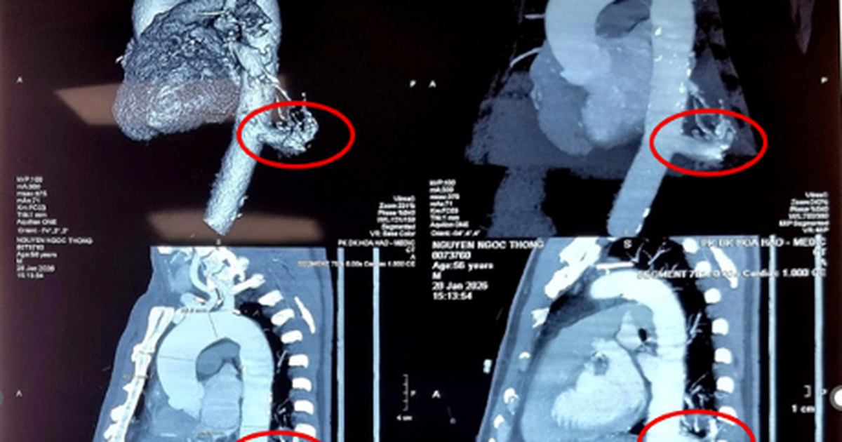 Việt Nam lần đầu dùng robot mổ điều trị phổi biệt lập thành công