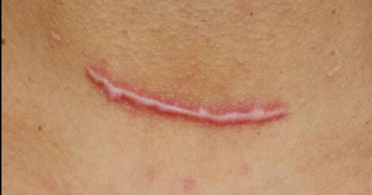 Áp lực cơ học và tăng sinh collagen: Góc nhìn mới trong phòng ngừa sẹo hậu phẫu