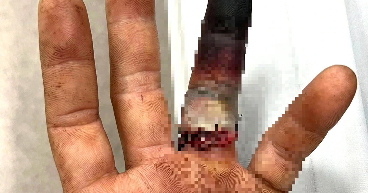 Nhẫn cưới mắc vào cửa xe, tài xế ở TP.HCM nguy cơ mất ngón tay