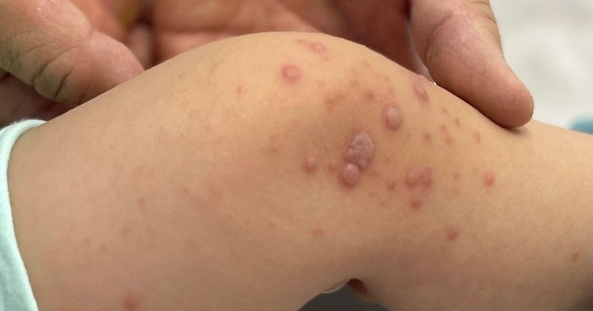 TP.HCM: Bệnh tay chân miệng tăng mạnh, hơn 8.150 ca mắc, 4 ca tử vong