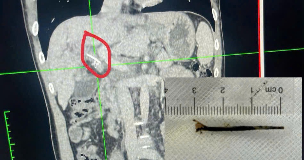 Hóc xương cá dài 3 cm xuyên vào đường mật... tưởng bị ung thư