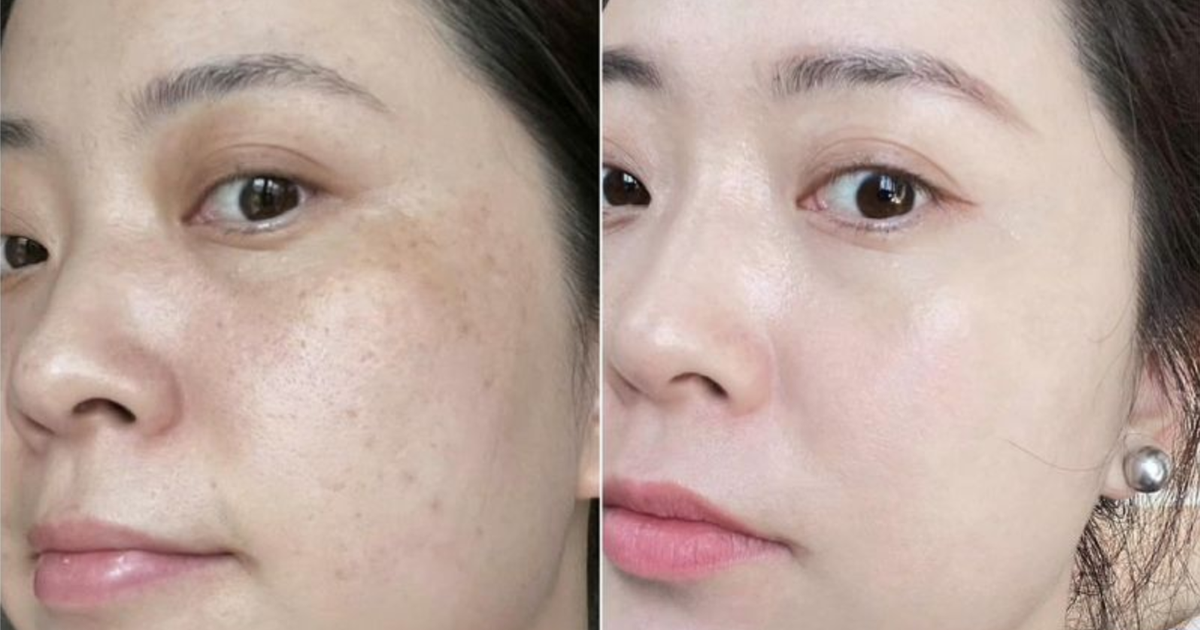 Top 5 kem giảm nám, đốm nâu hiệu quả sau 4 tuần, mờ cả nám lâu năm