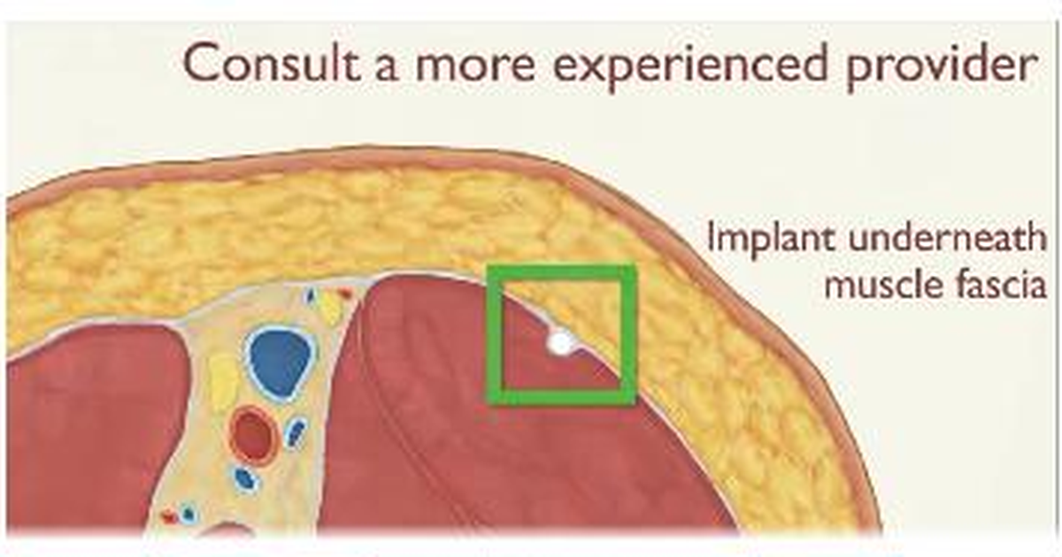 Bệnh viện Phương Nam xử trí ca que tránh thai xuyên sâu vào cơ hiếm gặp