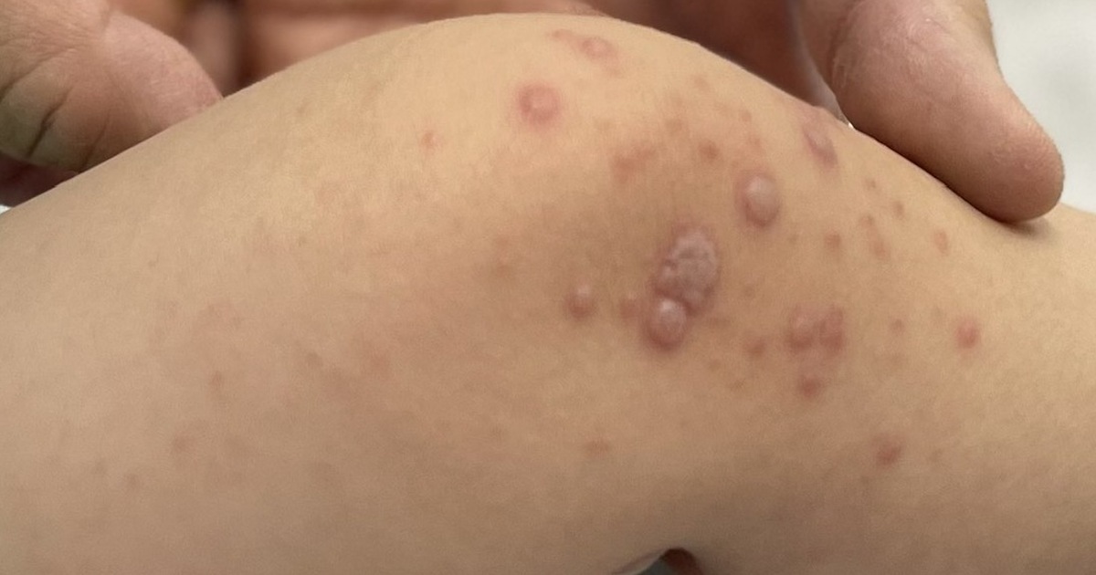 Việt Nam chờ vắc xin tay chân miệng nhập về hạ nhiệt dịch