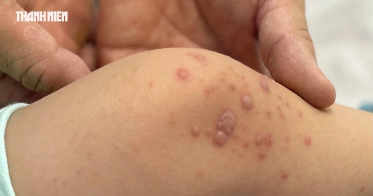 Bệnh tay chân miệng tăng cao: Vắc xin vẫn chờ công bố giá