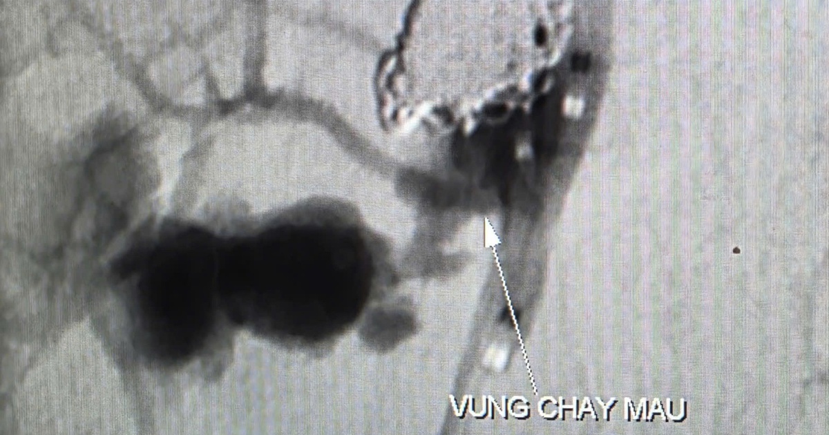 Cứu sống bệnh nhân ung thư chảy máu ồ ạt