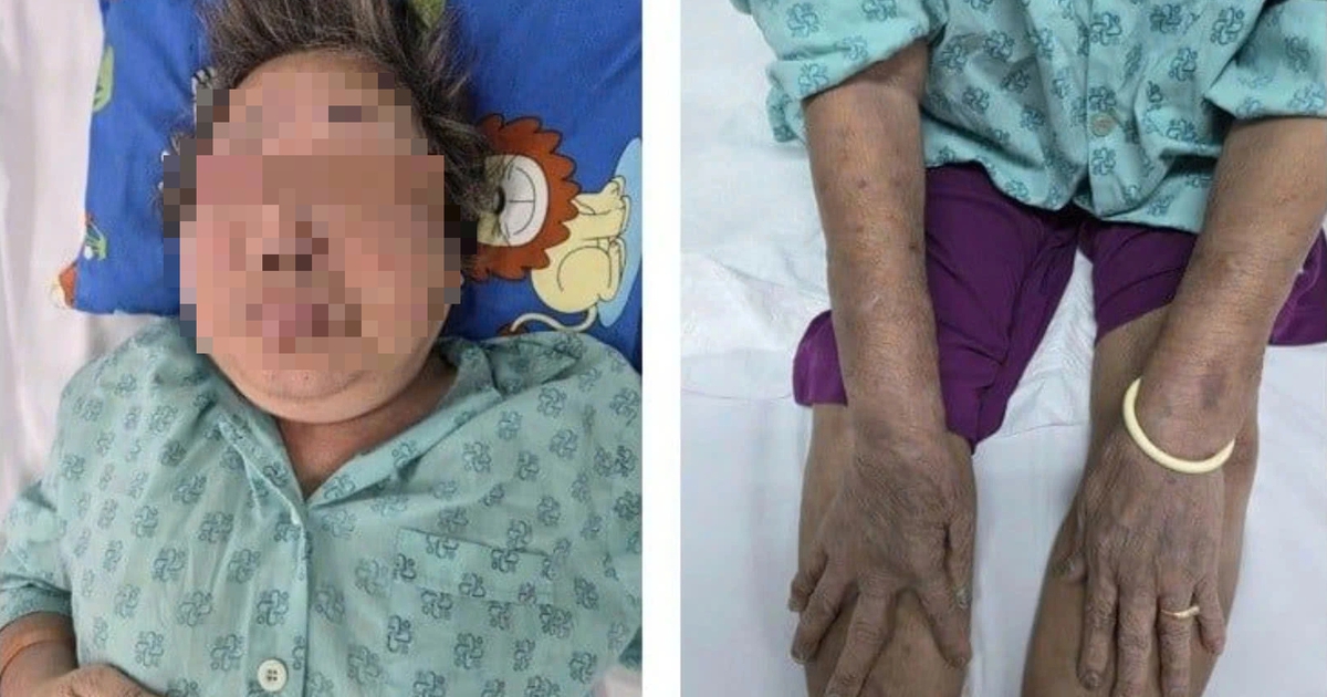 Tự uống thuốc giảm đau, cụ ông 87 tuổi nhập viện ở TP.HCM