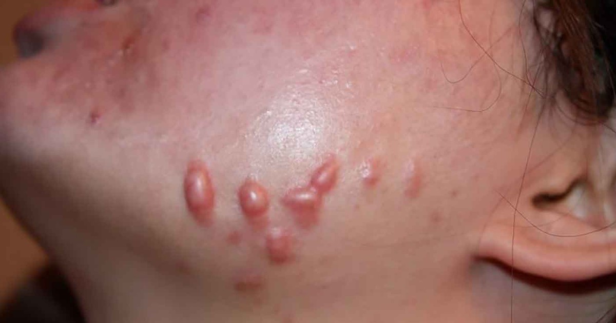 Chuyên gia Rejuvaskin bật mí cách mờ sẹo lồi do mụn hiệu quả theo đúng giai đoạn