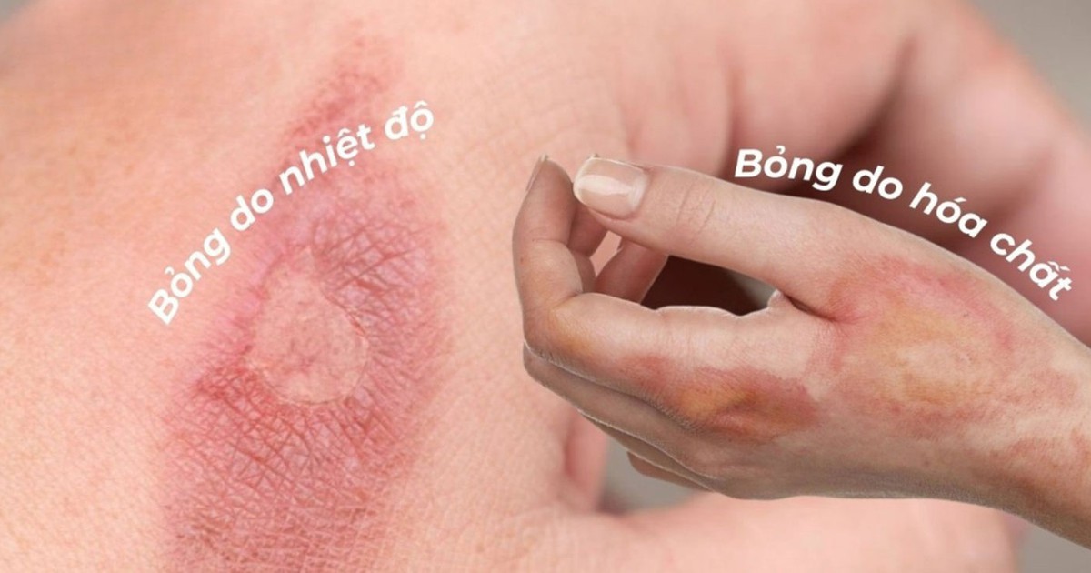 Quá trình lành vết bỏng: Sai một bước, sẹo cả đời