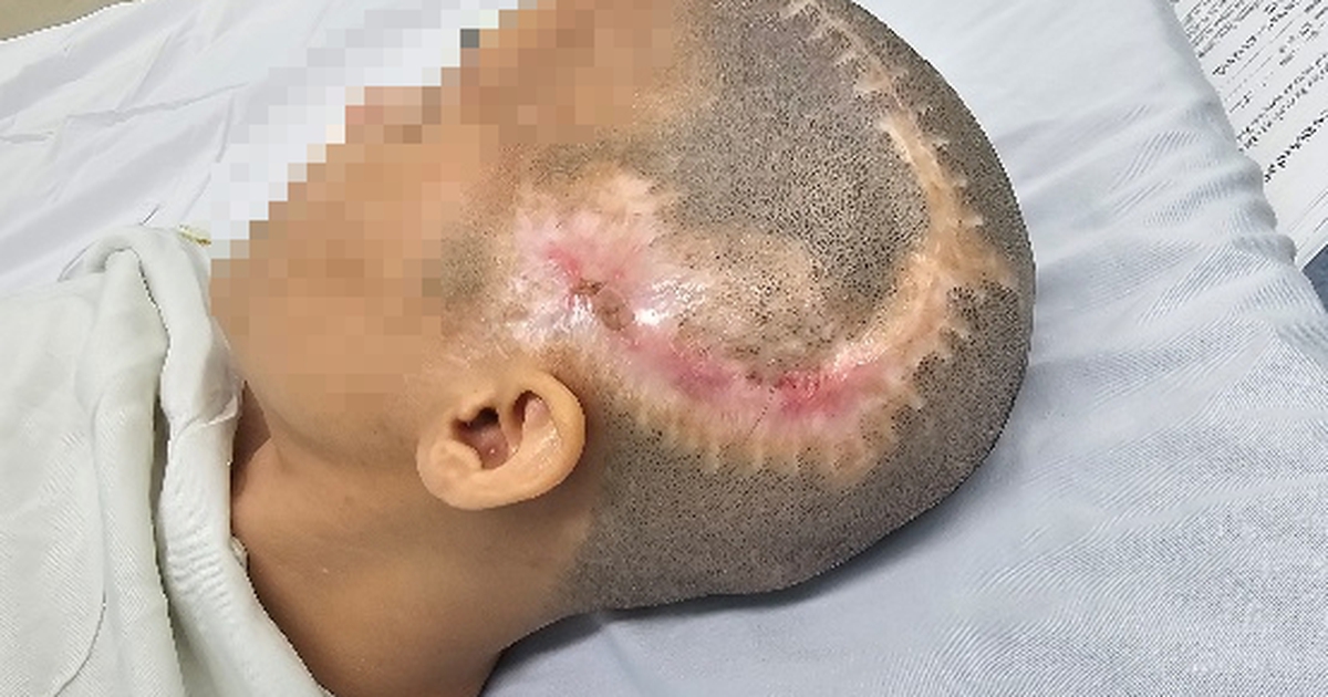 TP.HCM: Đột quỵ sau phẫu thuật thẩm mỹ hút mỡ bụng, cấy mỡ