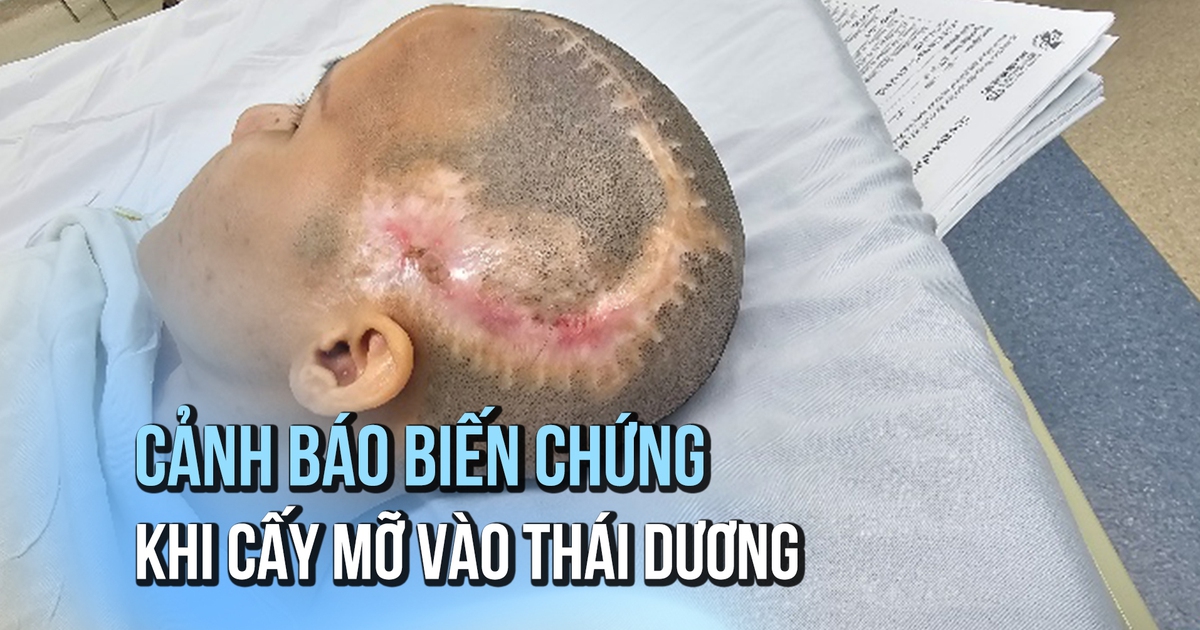 Khuyến cáo cấy mỡ vào thái dương gây biến chứng đột quỵ não