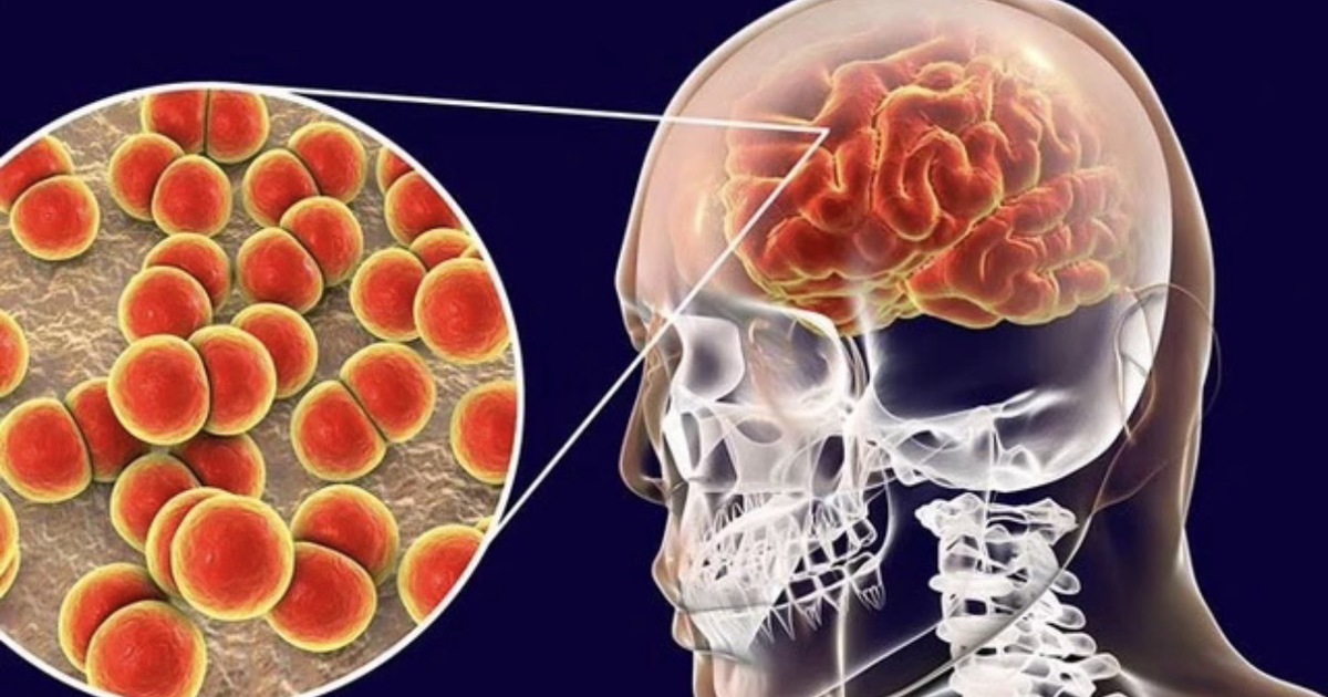 Cà Mau: Ghi nhận 3 ca nghi viêm não mô cầu, 1 ca tử vong