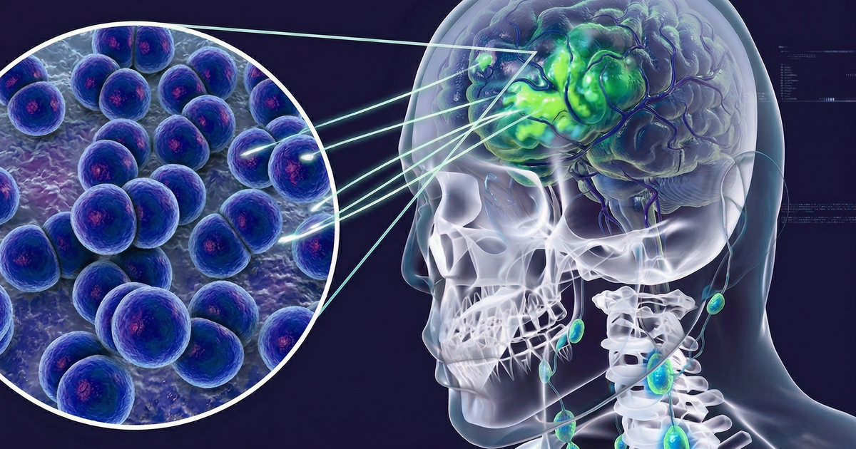 Cà Mau ghi nhận 3 ca nghi viêm não mô cầu, 1 trường hợp tử vong