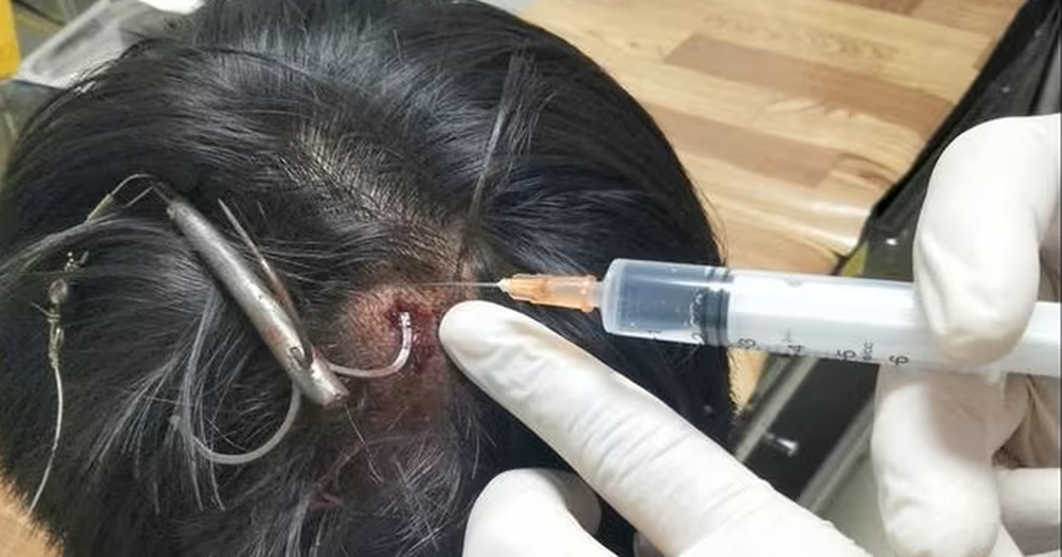 Móc câu 3 tiêu găm vào đầu khi câu cá, thiếu niên 15 tuổi nhập viện