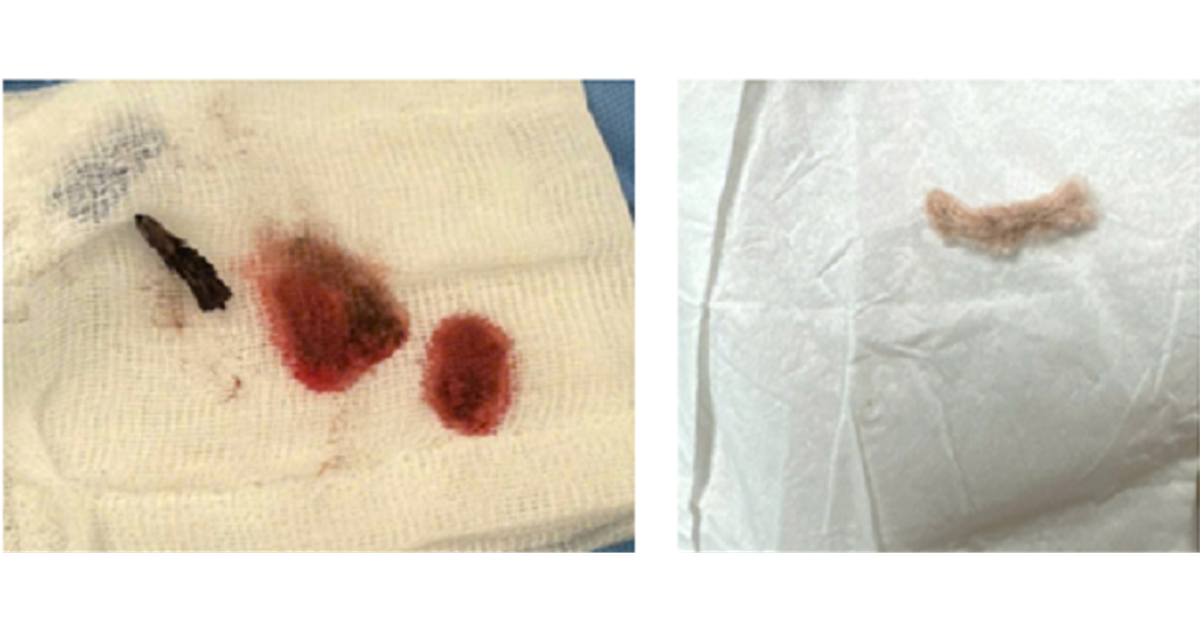 Ho ra máu, bé 3 tuổi nhập viện: Nguyên nhân từ dị vật dài 2 cm