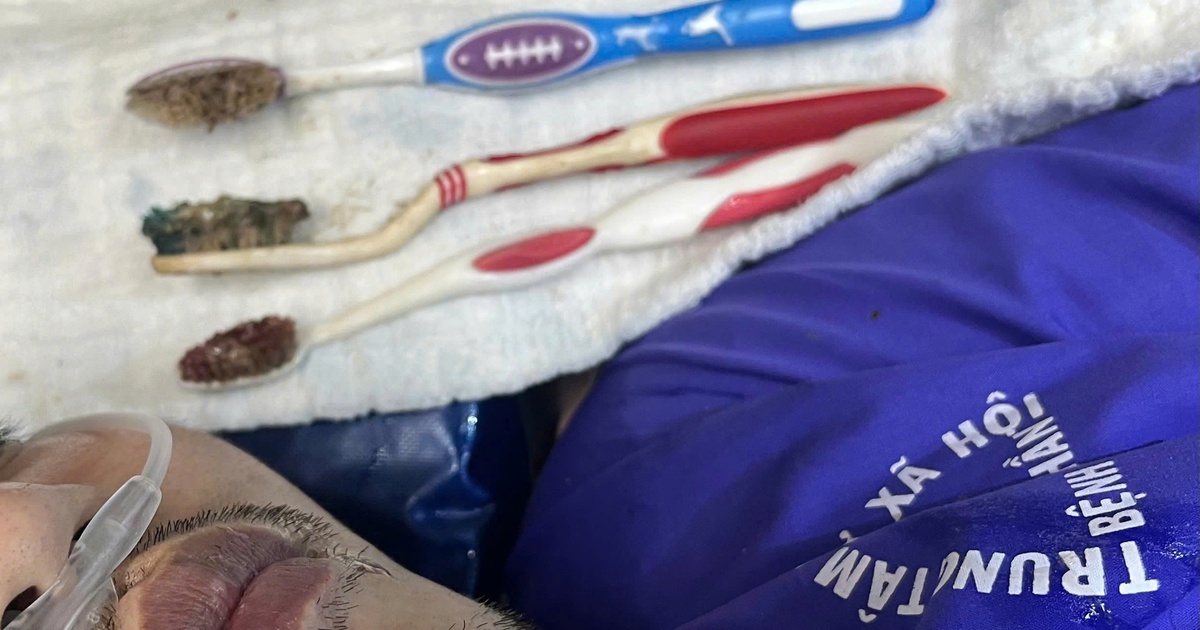 Nuốt 3 bàn chải đánh răng dài 20 cm, nam thanh niên nhập viện nguy kịch