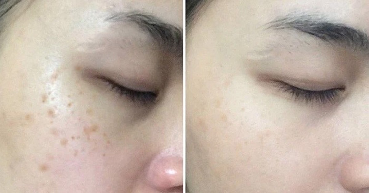 Top 5 serum giúp ‘tạm biệt’ nám, thậm chí nám hỗn hợp tưởng như chưa tồn tại