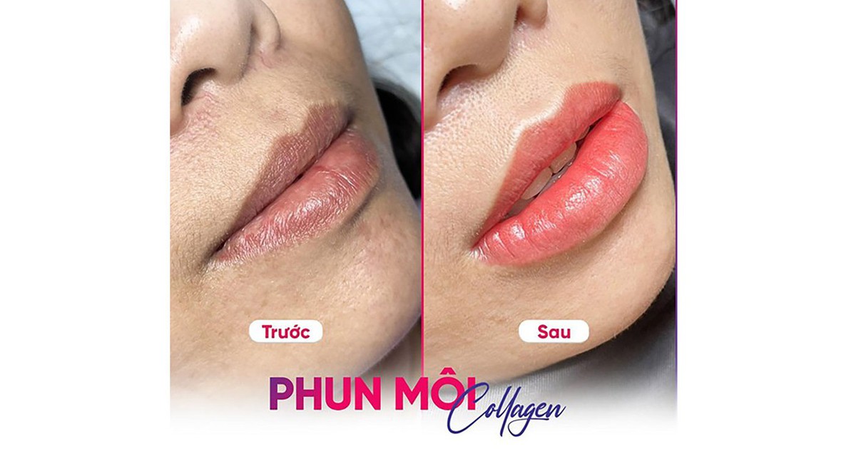 Thẩm mỹ viện Seoul Center - địa chỉ phun môi uy tín, đẹp, bền lâu