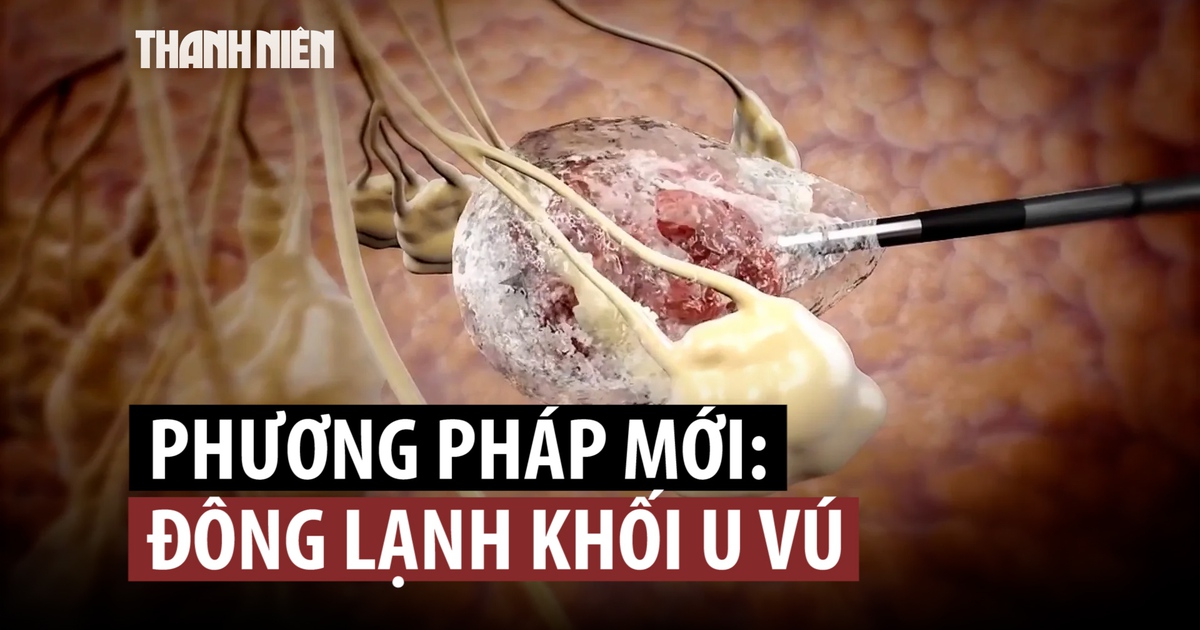 Phương pháp điều trị ung thư vú mới nhiều triển vọng