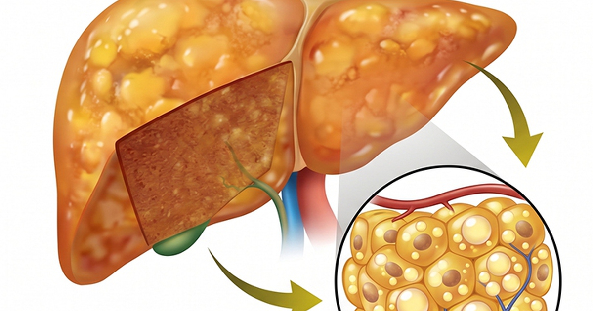 Gan nhiễm mỡ và máu nhiễm mỡ: Bệnh nào đáng lo hơn?