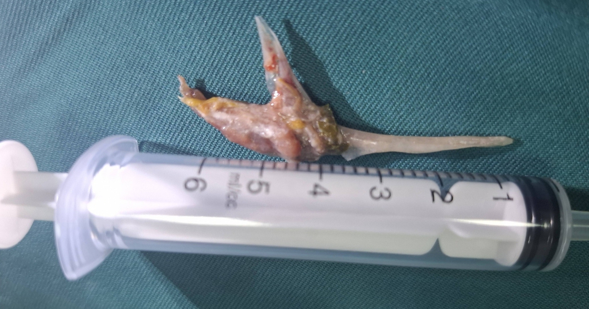 Nuốt đinh, hóc xương, rơi răng giả: Những ca cấp cứu khiến bác sĩ toát mồ hôi