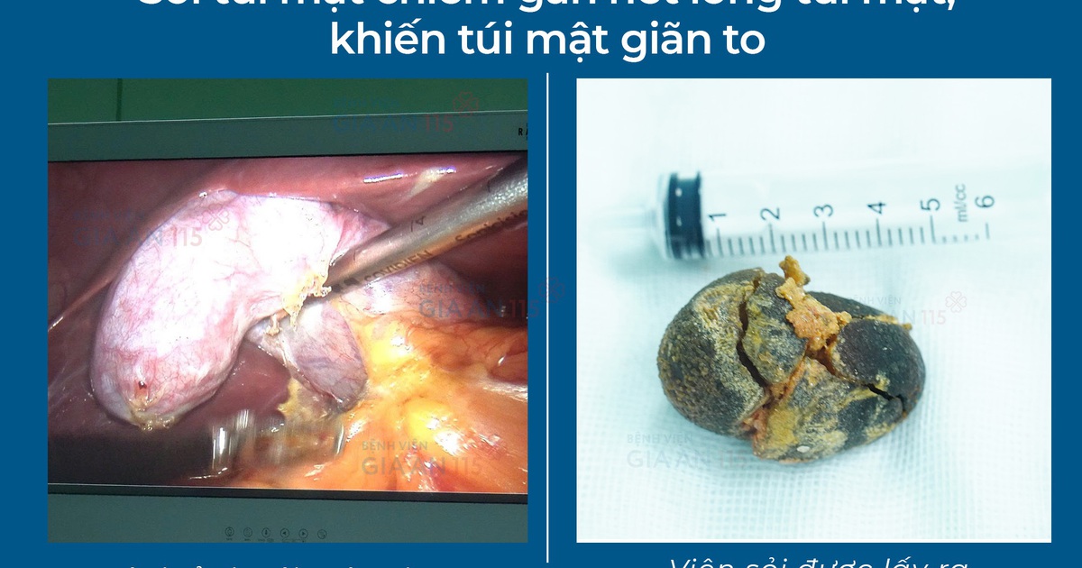 Phát hiện sỏi túi mật lớn gần bằng quả trứng gà khi khám sức khỏe định kỳ