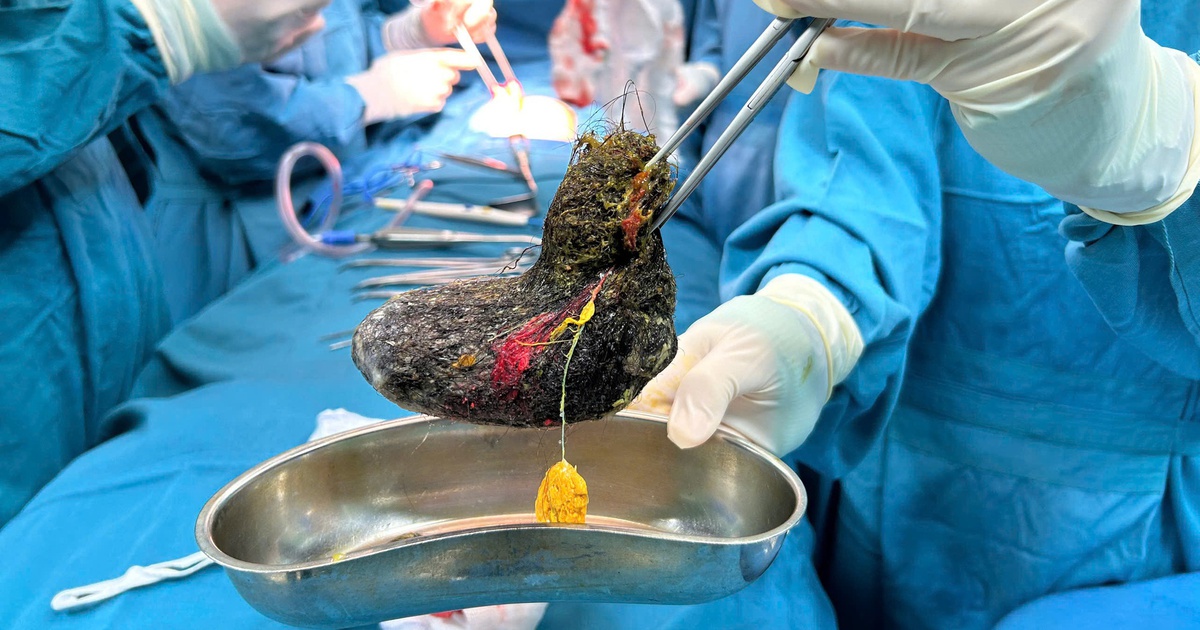 Búi tóc 'lấp kín' dạ dày bé gái 7 tuổi, cảnh báo hội chứng nguy hiểm