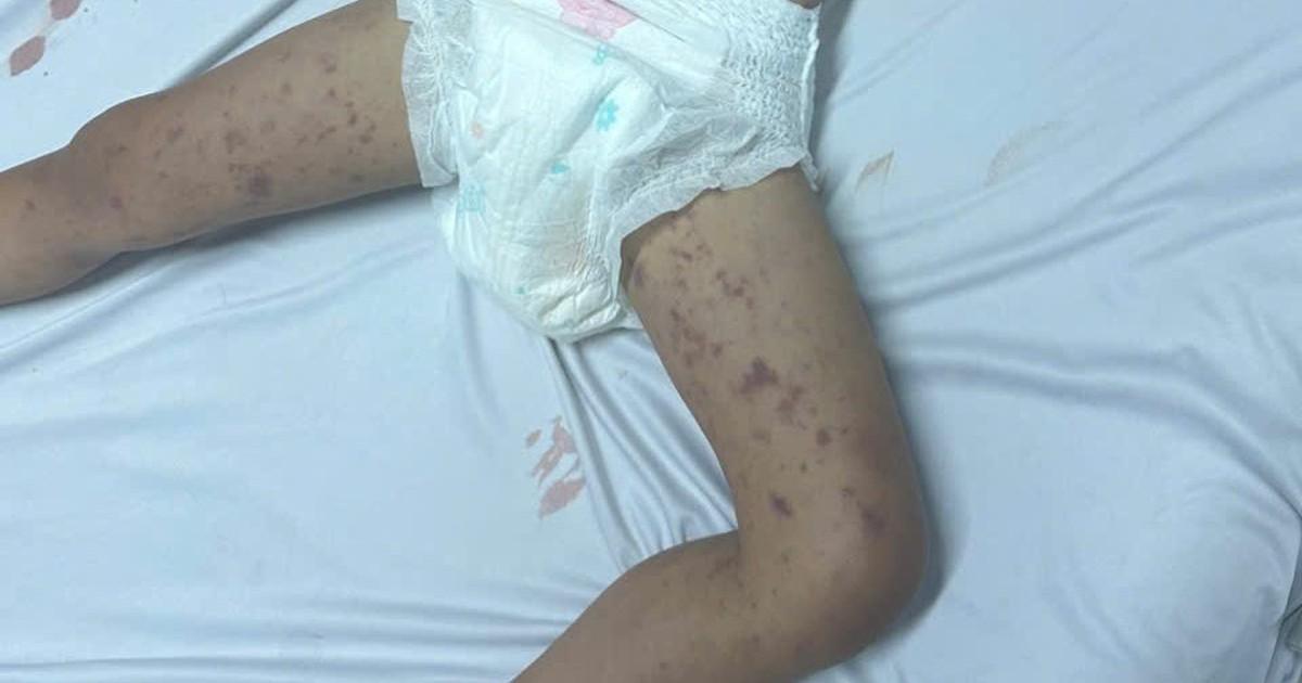 Xuất hiện viêm não mô cầu, Đắk Lắk khẩn trương truy vết người tiếp xúc