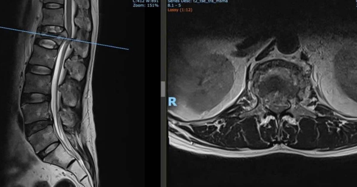 Cứu bệnh nhân bị hội chứng chùm đuôi ngựa do tai nạn lao động