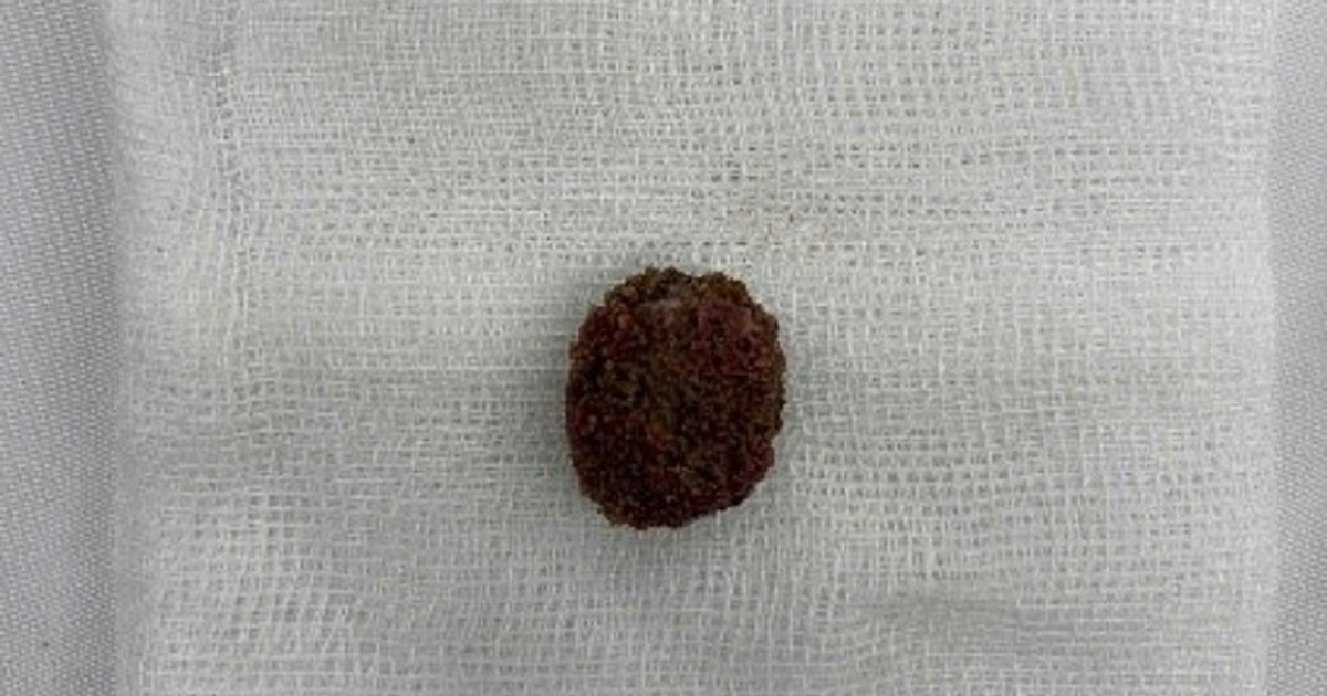 TP.HCM: Tin "thuốc tan sỏi thận" trên mạng, người đàn ông tắc nghẽn đường niệu