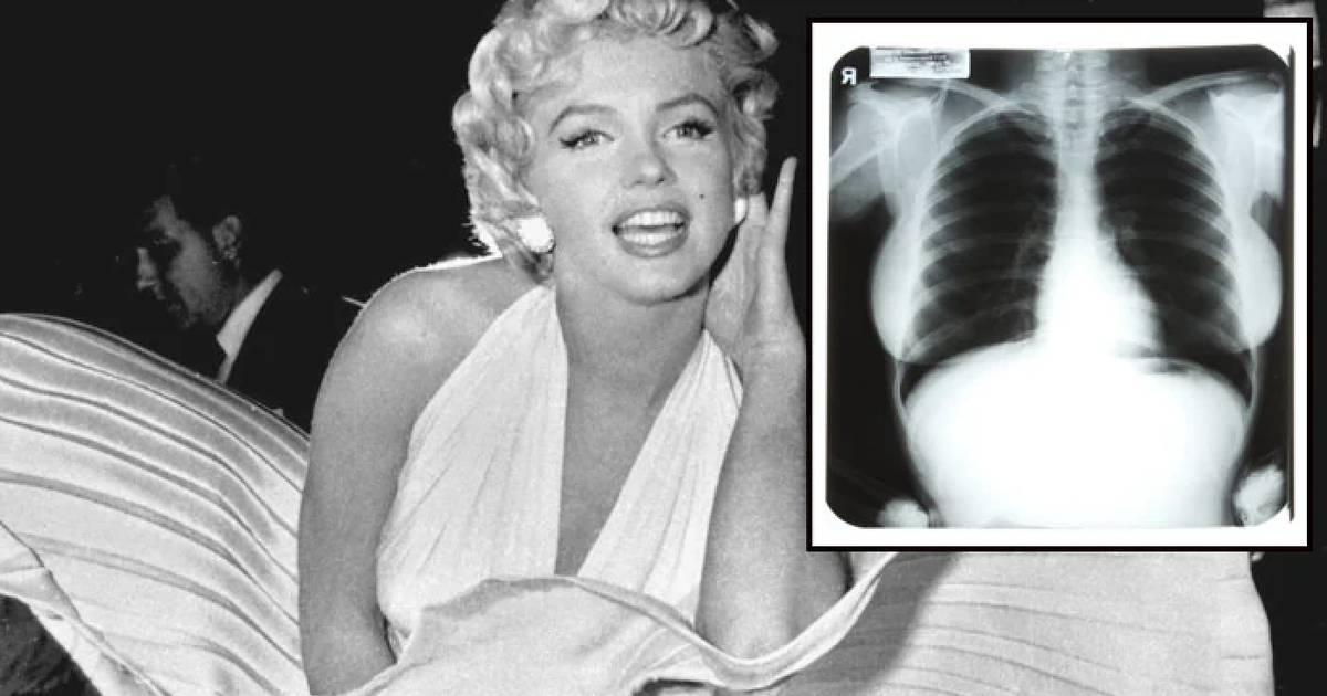 Ảnh X-quang của Marilyn Monroe gây phẫn nộ khi bị đấu giá