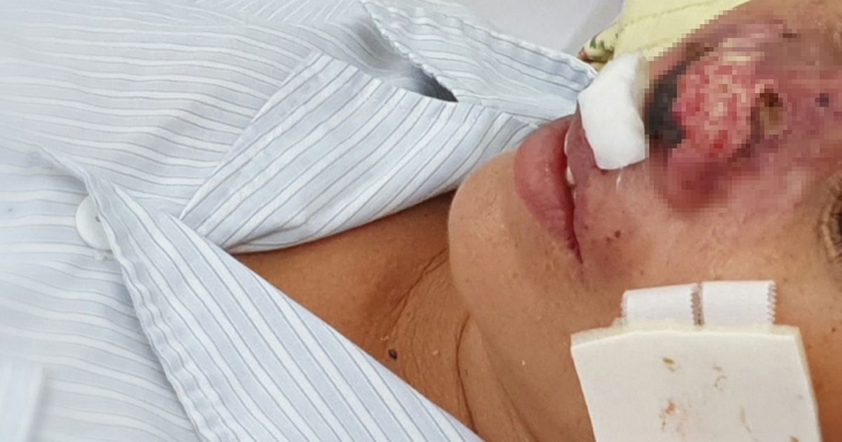 Bệnh 'sốt đất' dễ bị chẩn đoán nhầm và diễn biến nặng