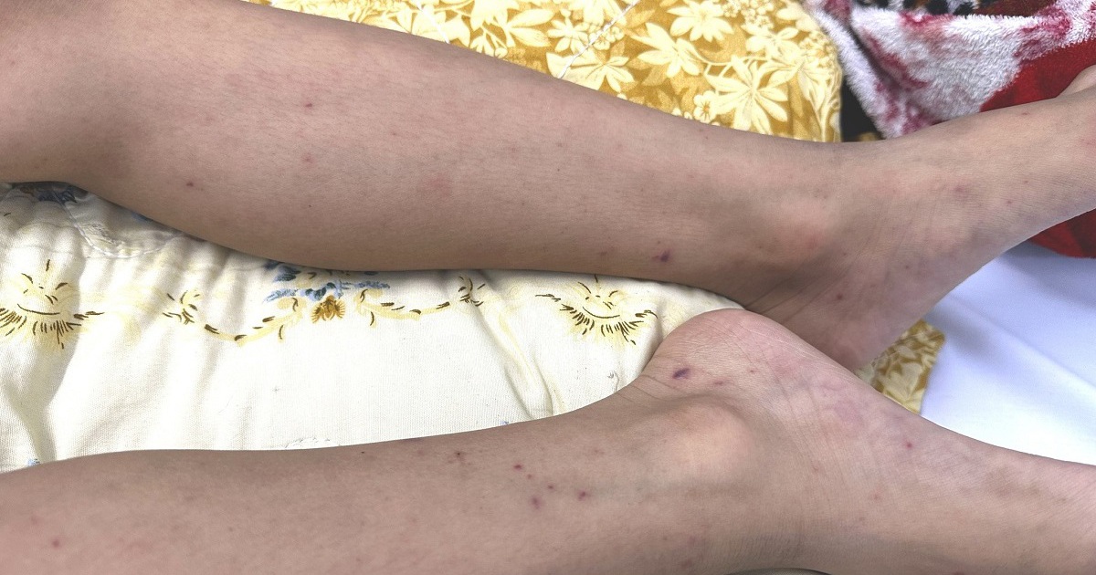 TP.HCM: Cứu sống bé trai 7 tuổi mắc não mô cầu