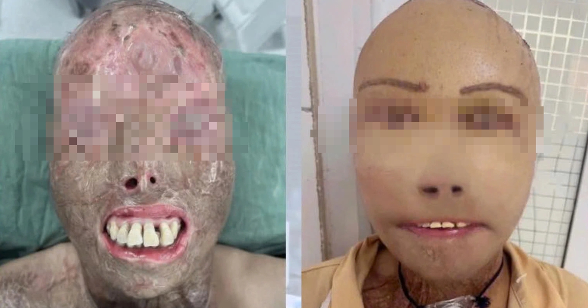 Ngã vào nồi nước sôi và hành trình 16 giờ 'trao trả' gương mặt