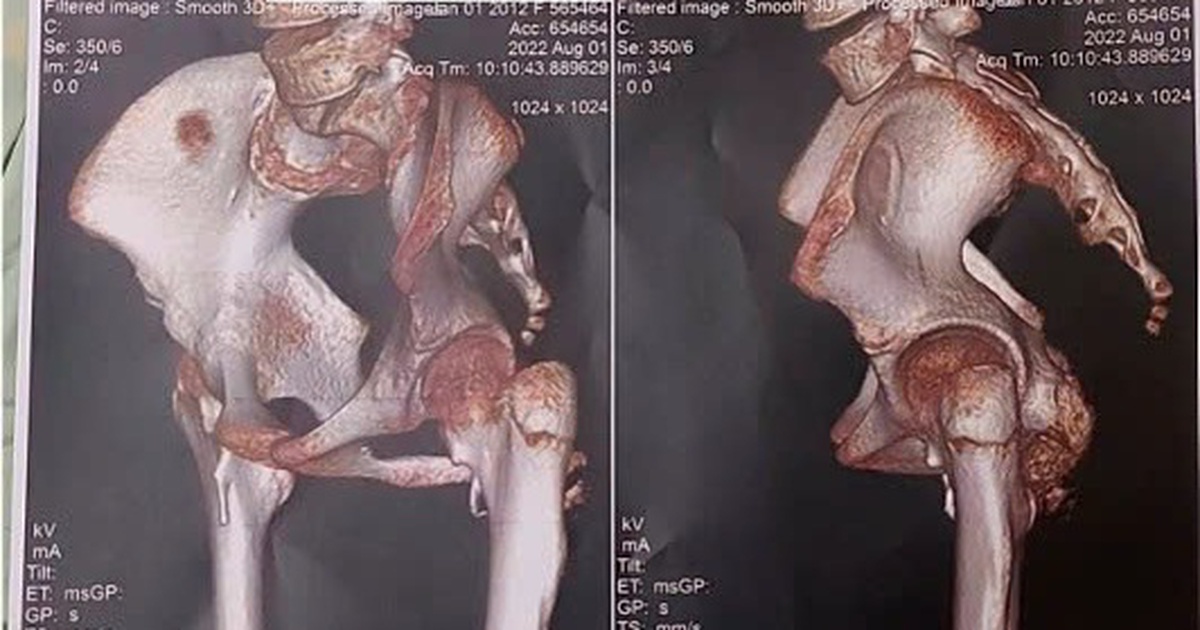TP.HCM: Giải mã gien phát hiện bé gái mắc hội chứng người hóa đá cực hiếm gặp