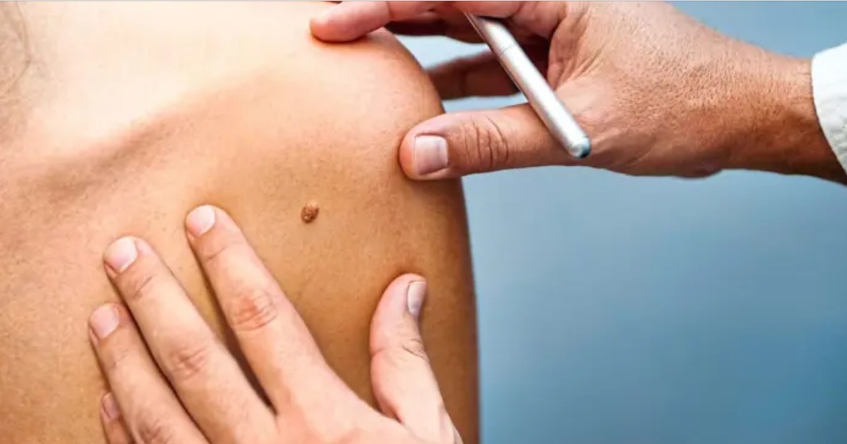 Công bố nghiên cứu mới về nốt ruồi và nguy cơ ung thư hắc tố da